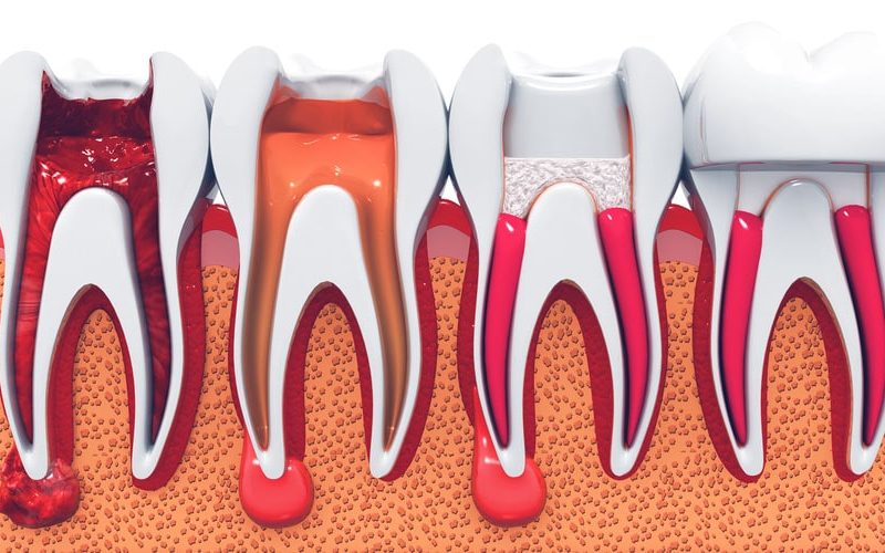 Endodontia: o que é e como ela pode contribuir no combate a dor de dente